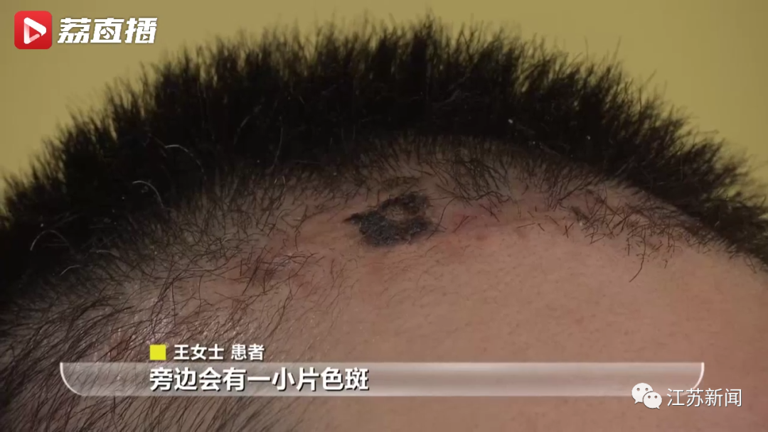 检查发现她患上了头皮恶性黑色素瘤,因头皮黑斑增大到南京鼓楼医院