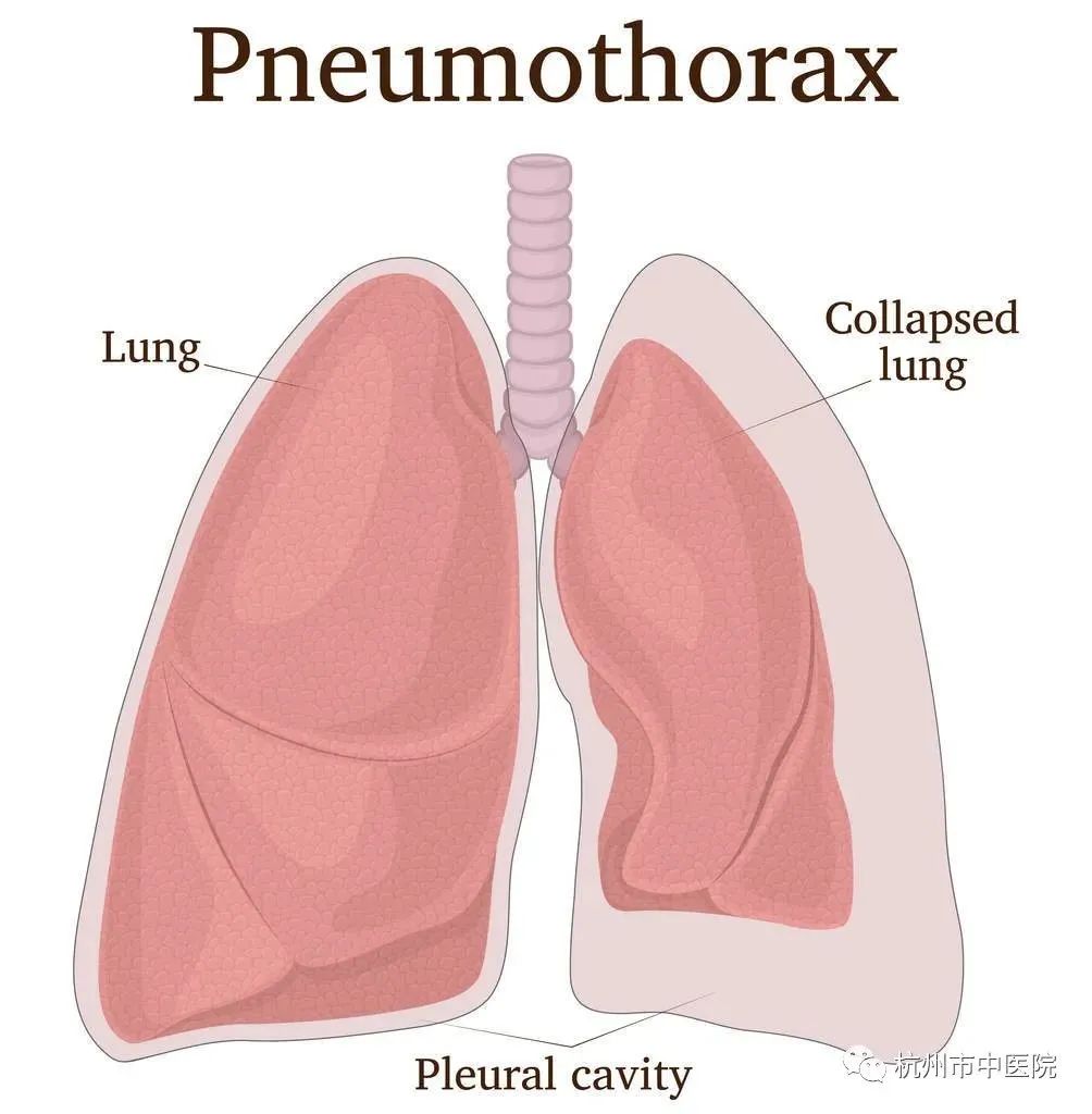 气胸图示:外部为胸膜腔,左侧为正常的肺,右侧为受挤压的肺