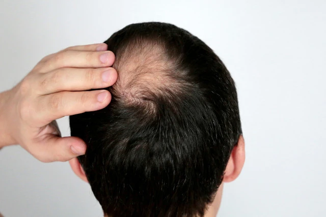 1/3的澳大利亚男性在30岁时严重脱发,到了40岁以后,一半的澳大利亚