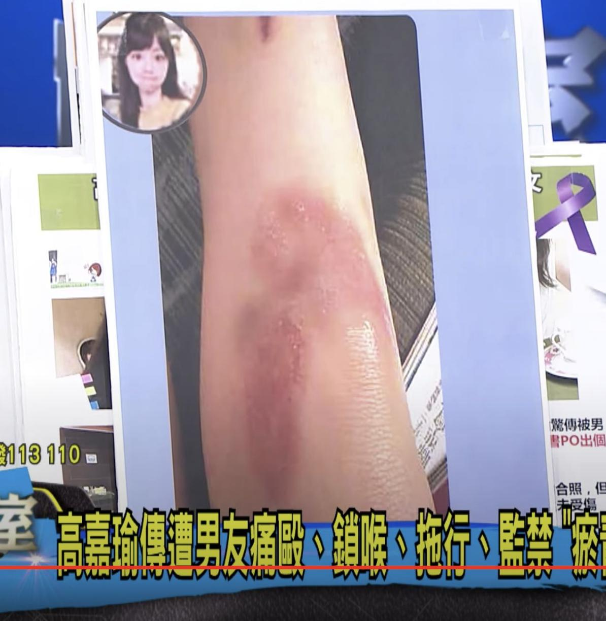 高嘉瑜被家暴打伤“严重瘀青照”曝光。图自台媒