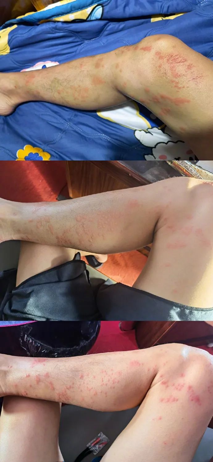 知名男星被水母蛰医生提醒游泳时千万别碰它严重可能丧命