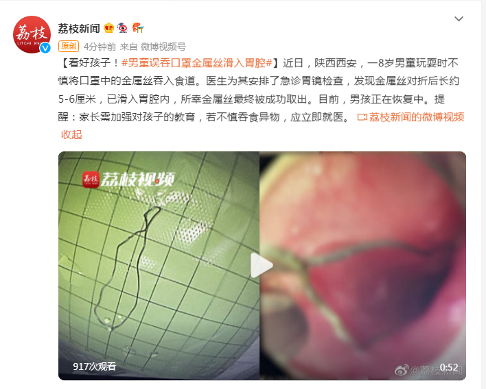 看好孩子男童误吞口罩金属丝滑入胃腔