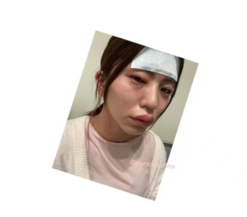 冈本璃奈称自己在接种疫苗后出现呼吸困难,上唇肿胀,身体麻痹等急性过敏性反应(图片来源:社交媒体)
