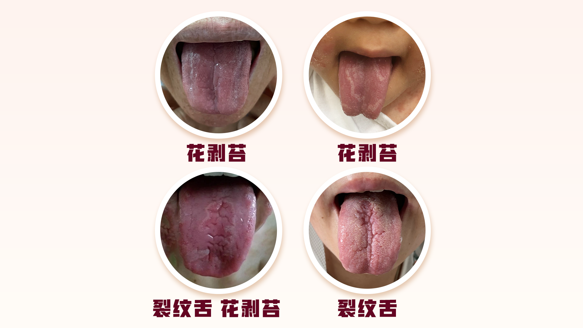 舌头毛状白斑图片_艾滋病图片_艾测网