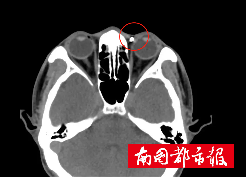 海口市人民医院眼科主任谢青综合分析病人病情后指出:异物在患者体内