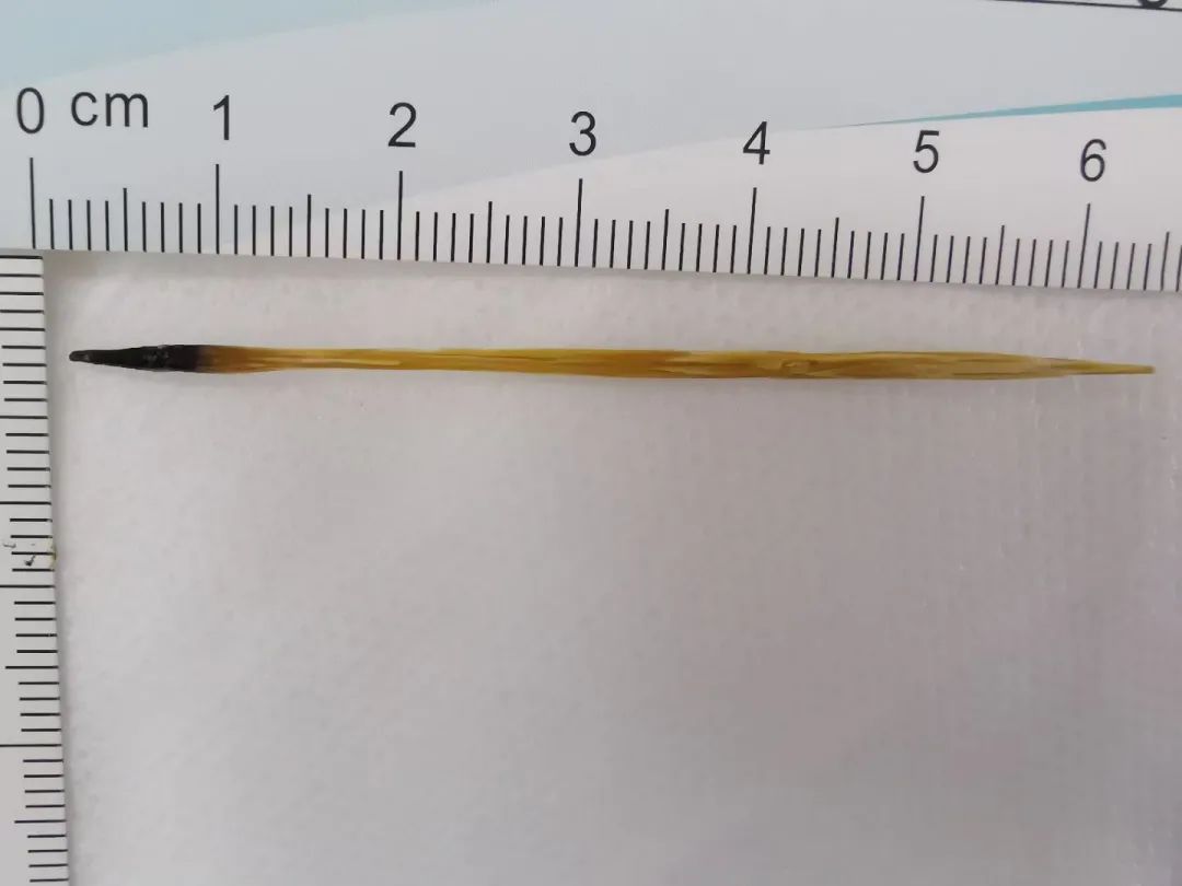 惊了男子经常肚子疼以为是肠胃不好结果取出65厘米长