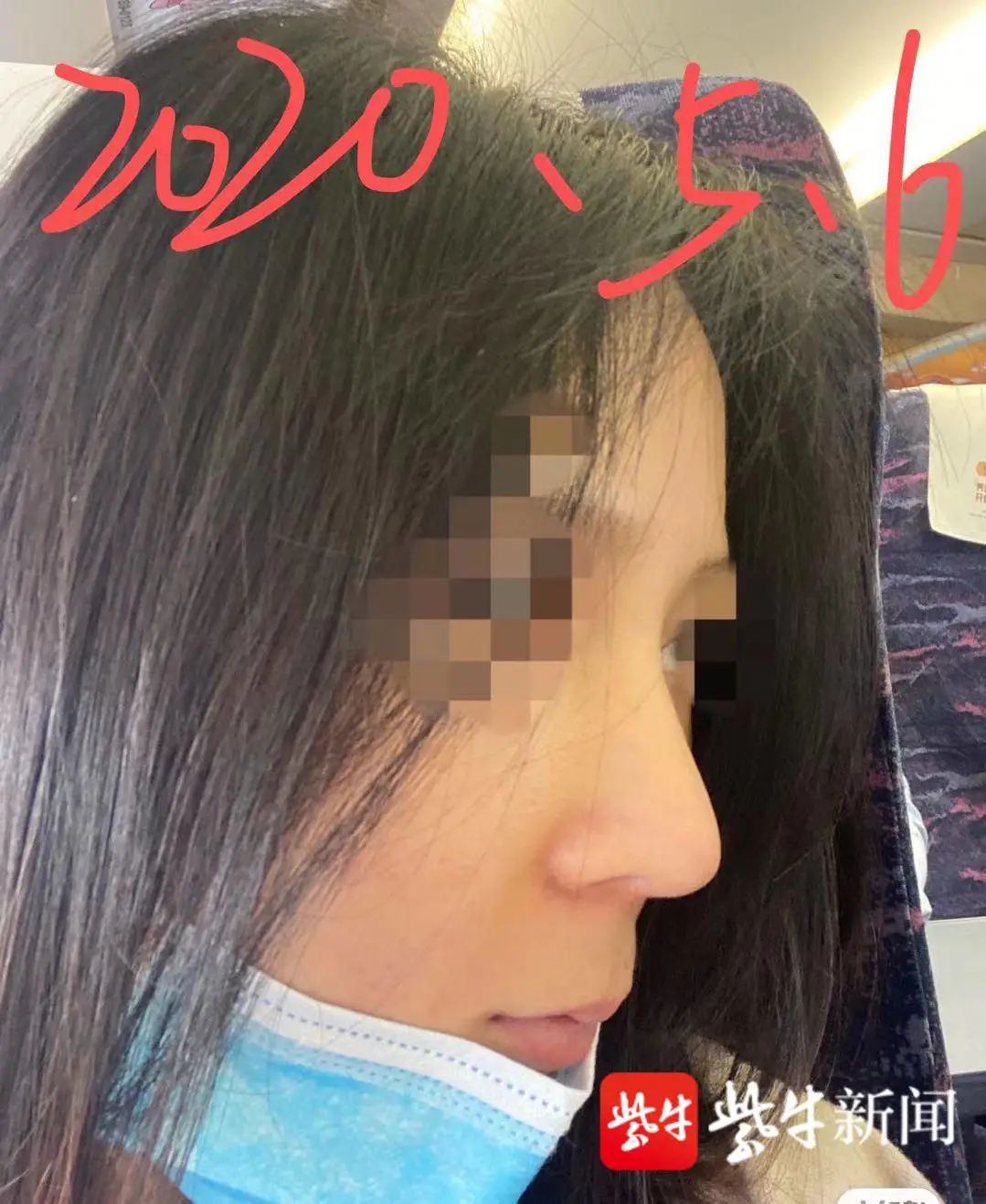 女子整容后山根晃动,鼻尖发白!手术方:很成功,已起诉