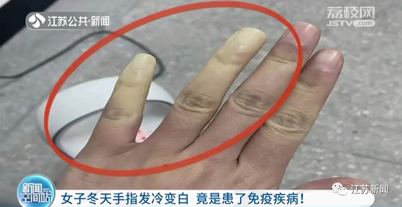 女子冬天手指发冷变白冻伤了其实是患了这种病