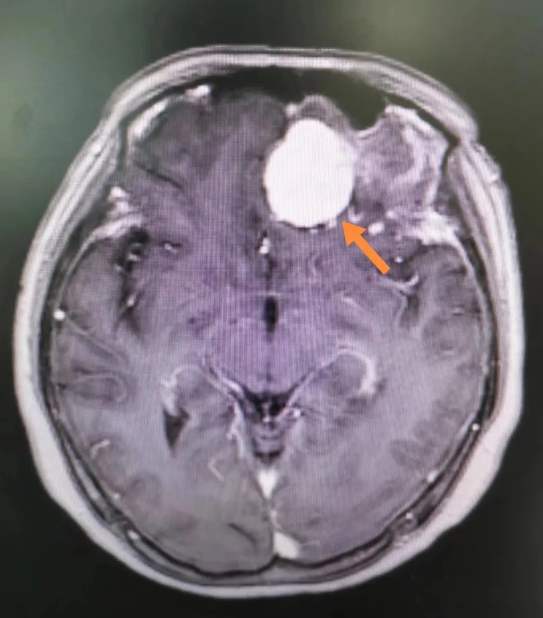 脑瘤核磁共振图片图片