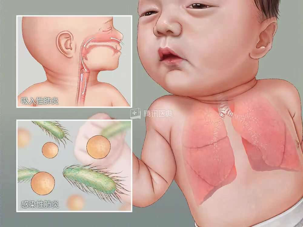 新生儿肺炎的症状图片图片