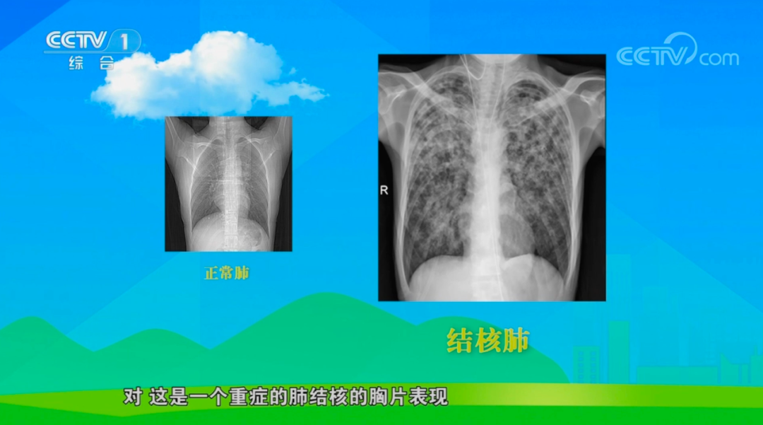 潜伏在身边!结核病菌有多狡猾?如何科学防治?一文了解