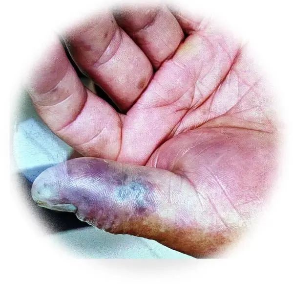 沈伯受伤的左大拇指。图源：澎湃新闻