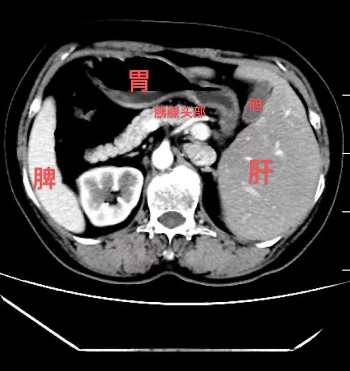 陈姨的腹部CT，内脏完全“长反了”