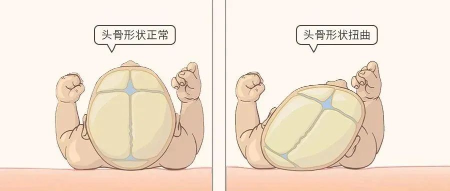 戴28万元头盔让婴儿头型变好看医生紧急提醒