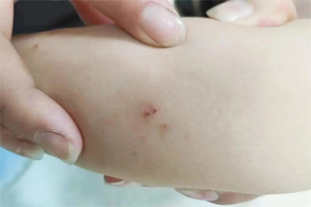 会致命!6岁男孩在家门口被咬了一口