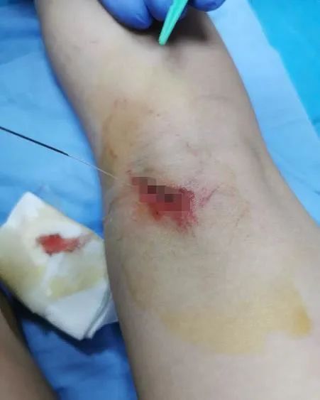 一声巨响2斤多重乌龟从天而降7岁孩子腿被砸中不能弯曲