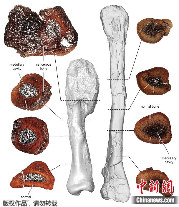 性腓骨进行了比较。据了解，骨肉瘤是一种骨癌，在人类中多发于青少年。