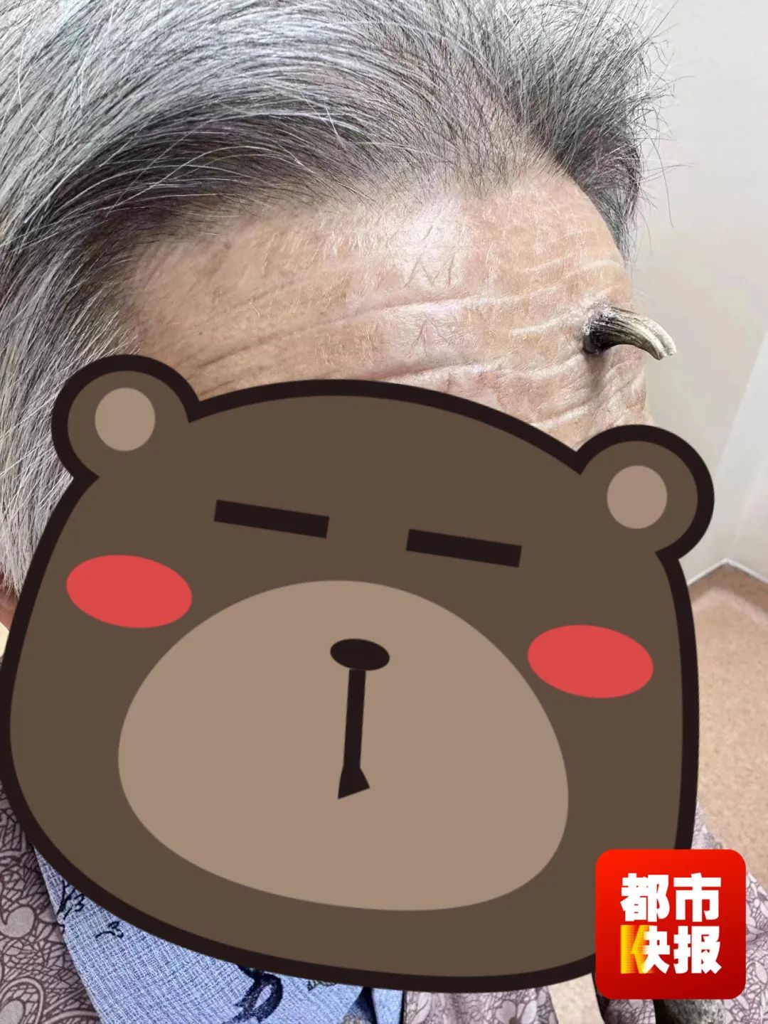 罕见!西安九旬老太额头上竟长出“犄角”……