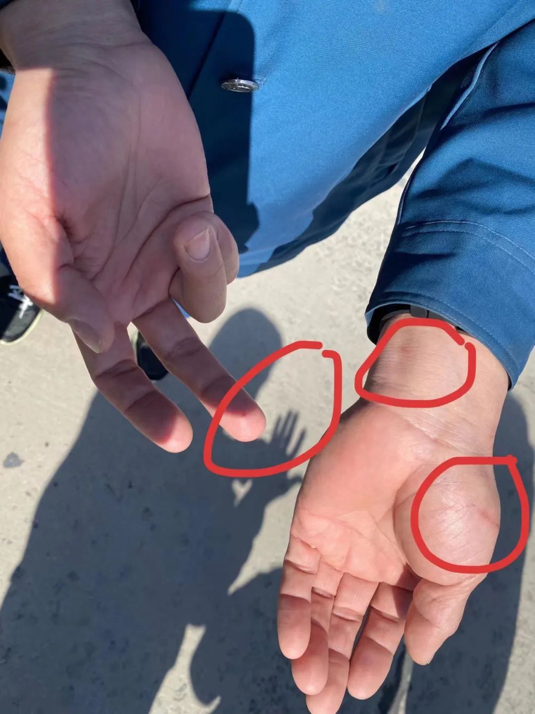 公交司机葛红彬手上被玻璃划伤的裂口仍依稀可见。本报首席记者 刘琛敏 摄