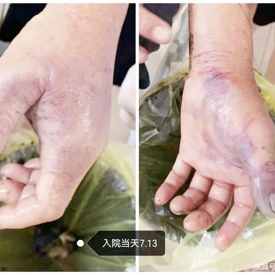 长沙大爷被黄鸭叫刺伤拇指截肢险丧命处理鱼一定要小心