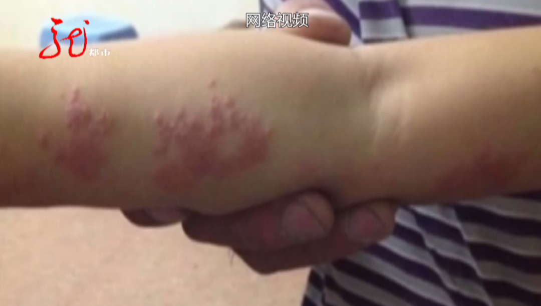 女子身上盘了条蛇疼得受不了医生有些患者甚至因此自杀