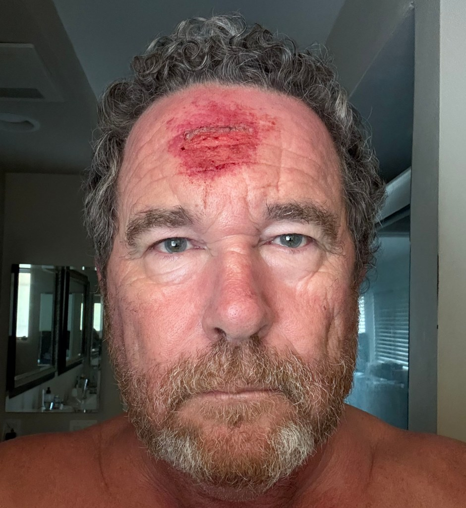 美媒摄影记者的前额有严重瘀伤。图源:美媒